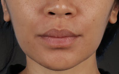 Lip Lift Before & After Gallery - Patient 366684 - Image 1