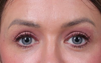 Blepharoplasty Before & After Gallery - Patient 390022 - Image 2