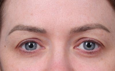Blepharoplasty Before & After Gallery - Patient 390022 - Image 1