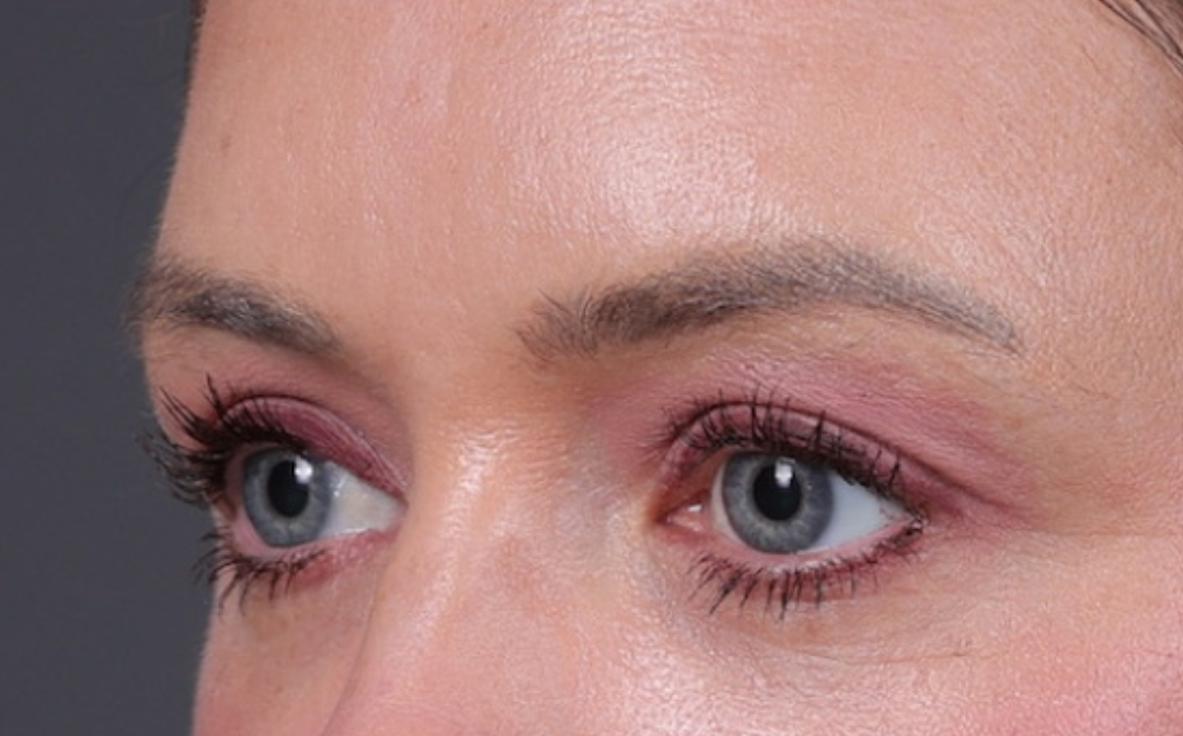 Blepharoplasty Before & After Gallery - Patient 390022 - Image 6