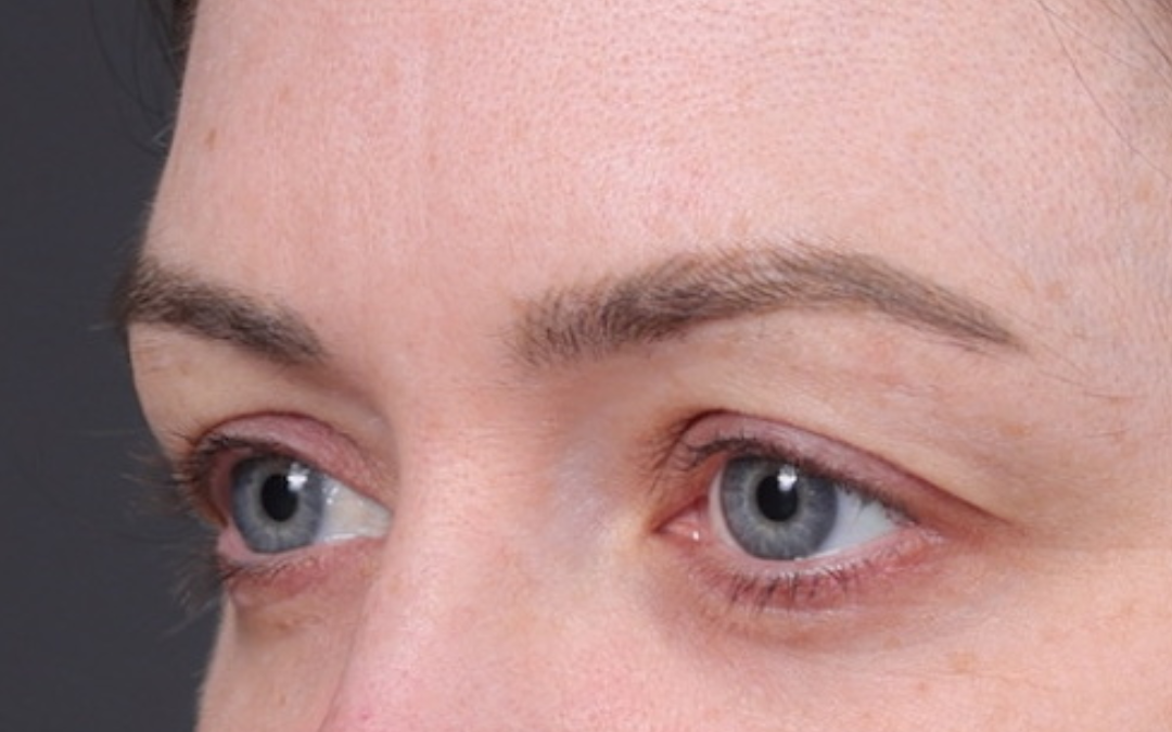 Blepharoplasty Before & After Gallery - Patient 390022 - Image 5