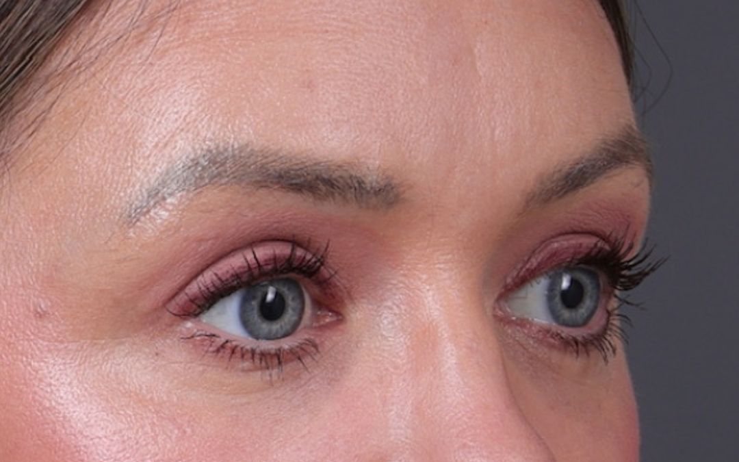 Blepharoplasty Before & After Gallery - Patient 390022 - Image 4
