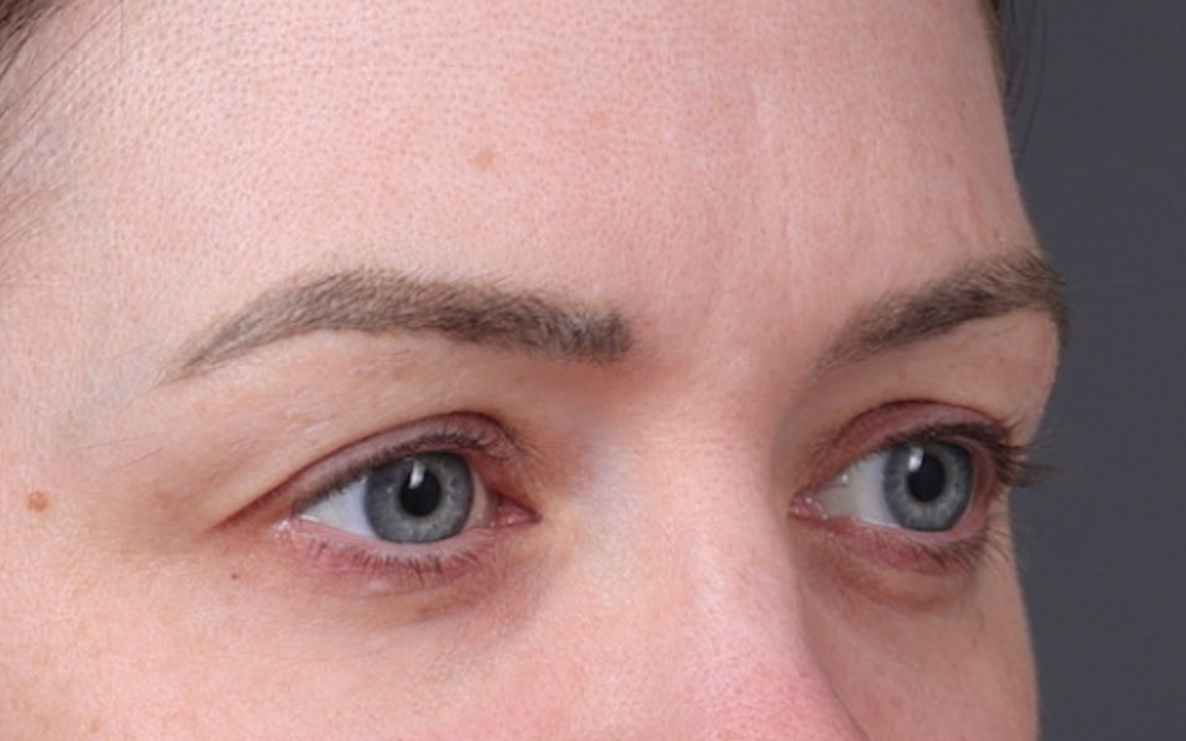Blepharoplasty Before & After Gallery - Patient 390022 - Image 3