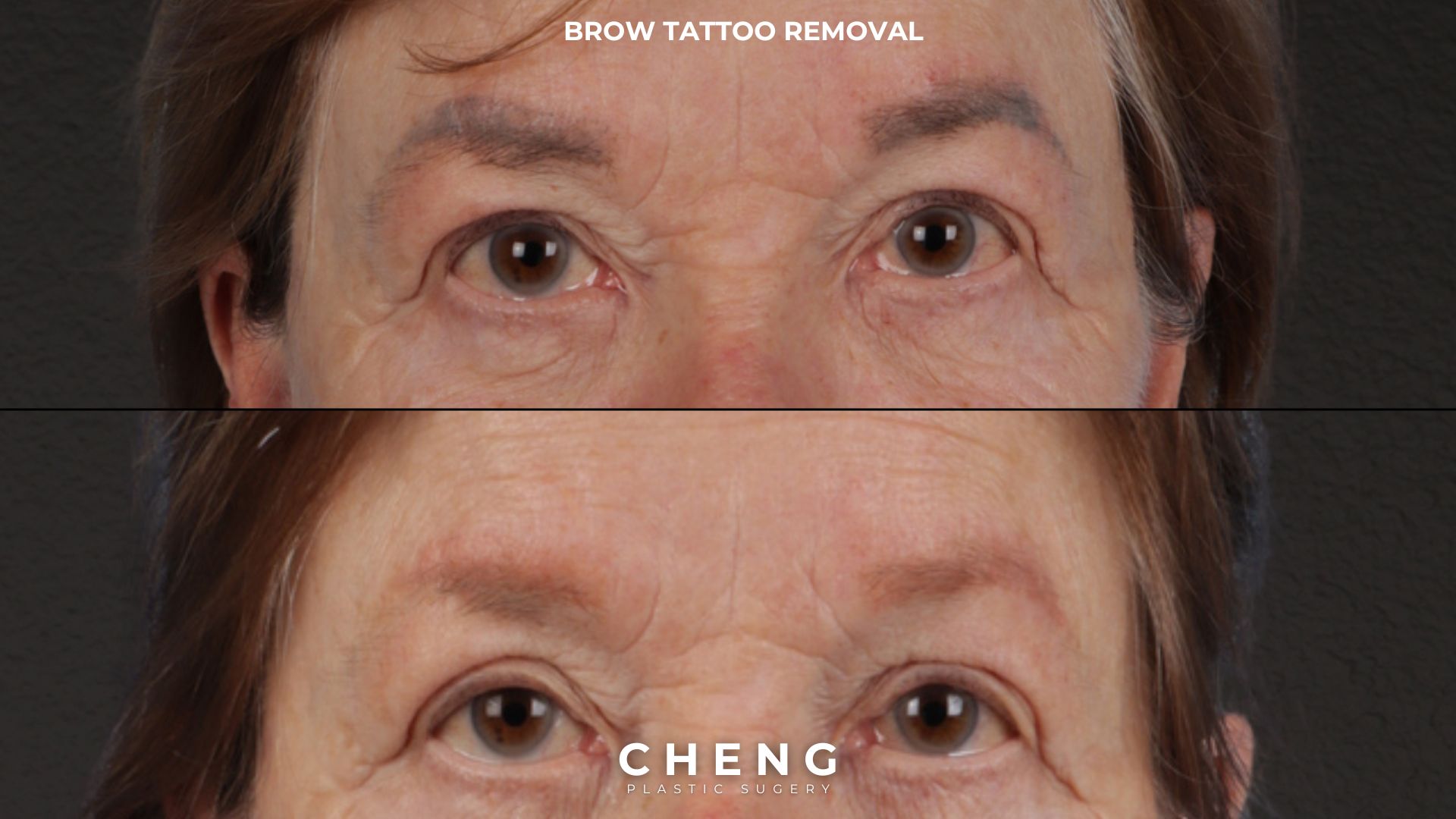 Laser Tattoo Removal Before & After Gallery - Patient 139243 - Image 1