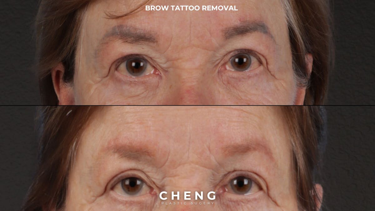 Laser Tattoo Removal Before & After Gallery - Patient 139243 - Image 1