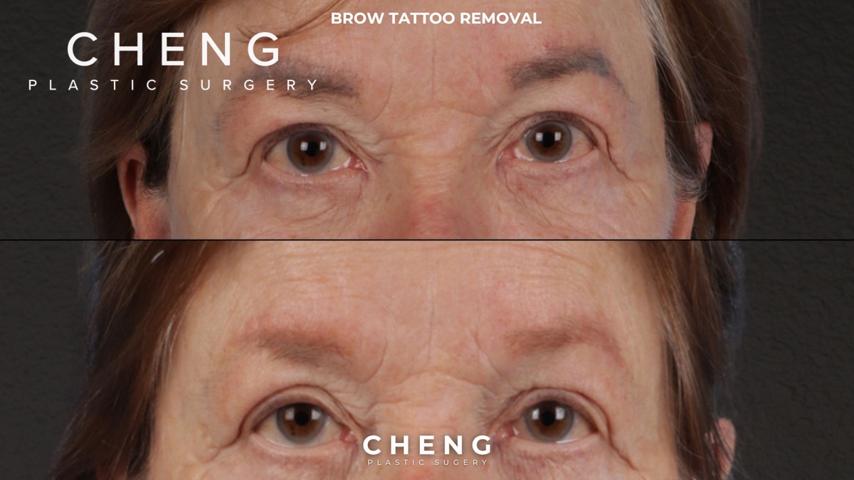 Laser Tattoo Removal Before & After Gallery - Patient 139243 - Image 1