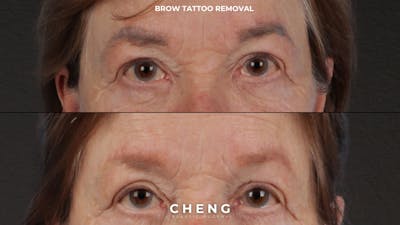 Laser Tattoo Removal Before & After Gallery - Patient 139243 - Image 1