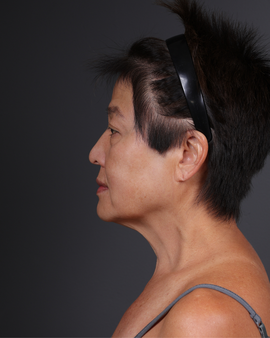 Facelift Before & After Gallery - Patient 285357 - Image 9