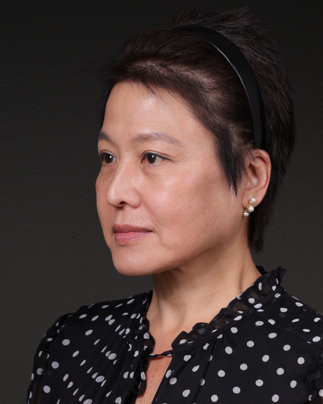 Facelift Before & After Gallery - Patient 285357 - Image 8