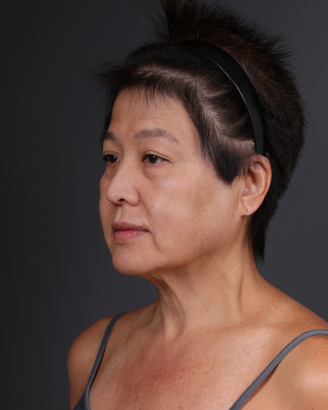 Facelift Before & After Gallery - Patient 285357 - Image 7
