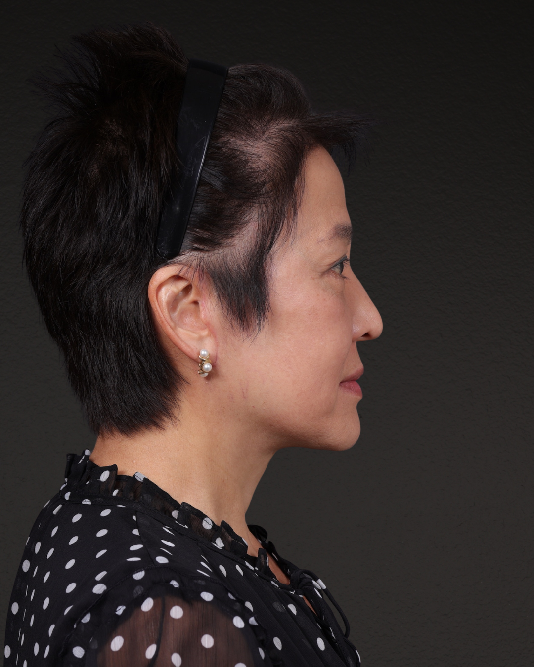 Facelift Before & After Gallery - Patient 285357 - Image 6