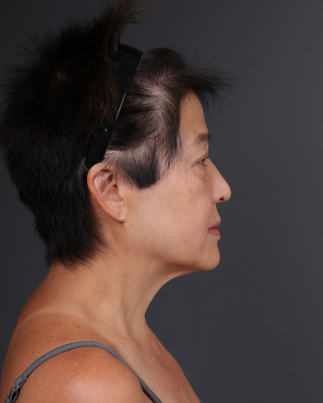 Facelift Before & After Gallery - Patient 285357 - Image 5