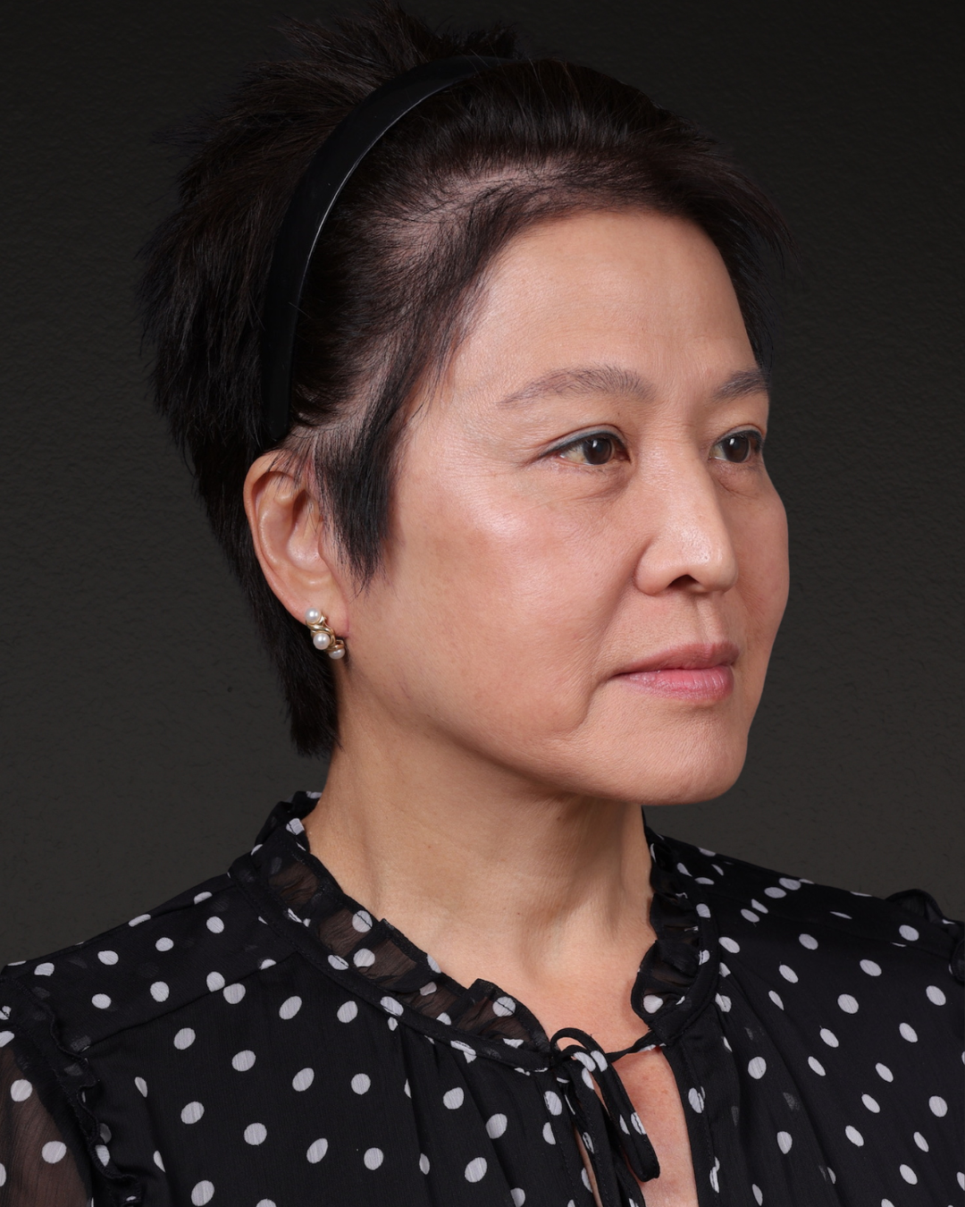 Facelift Before & After Gallery - Patient 285357 - Image 4