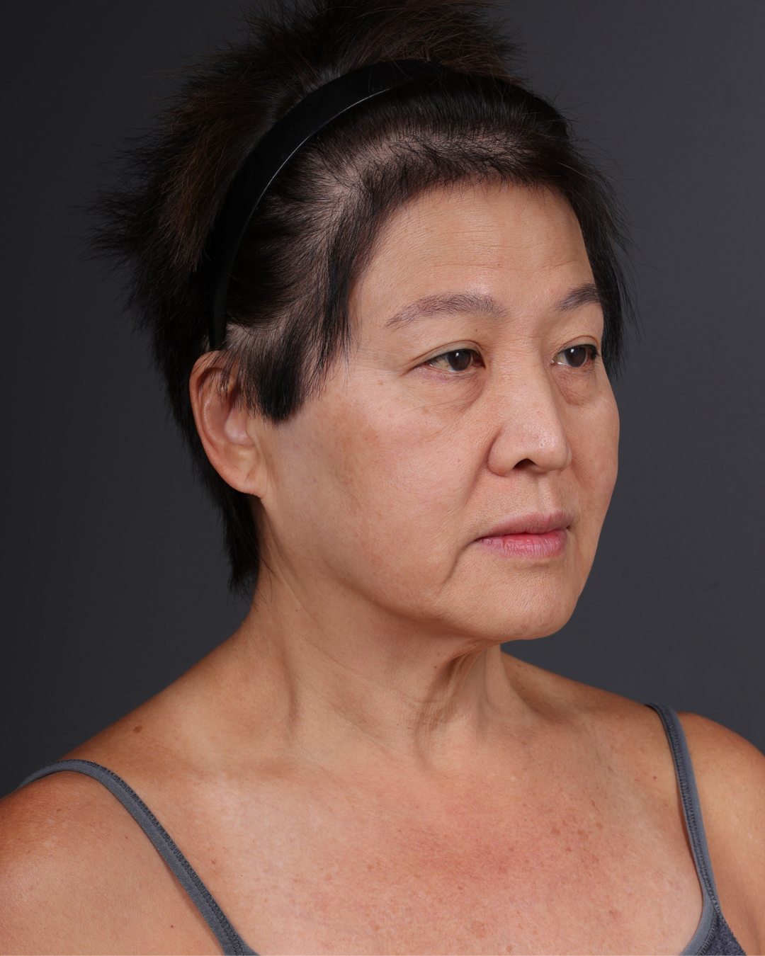 Facelift Before & After Gallery - Patient 285357 - Image 3