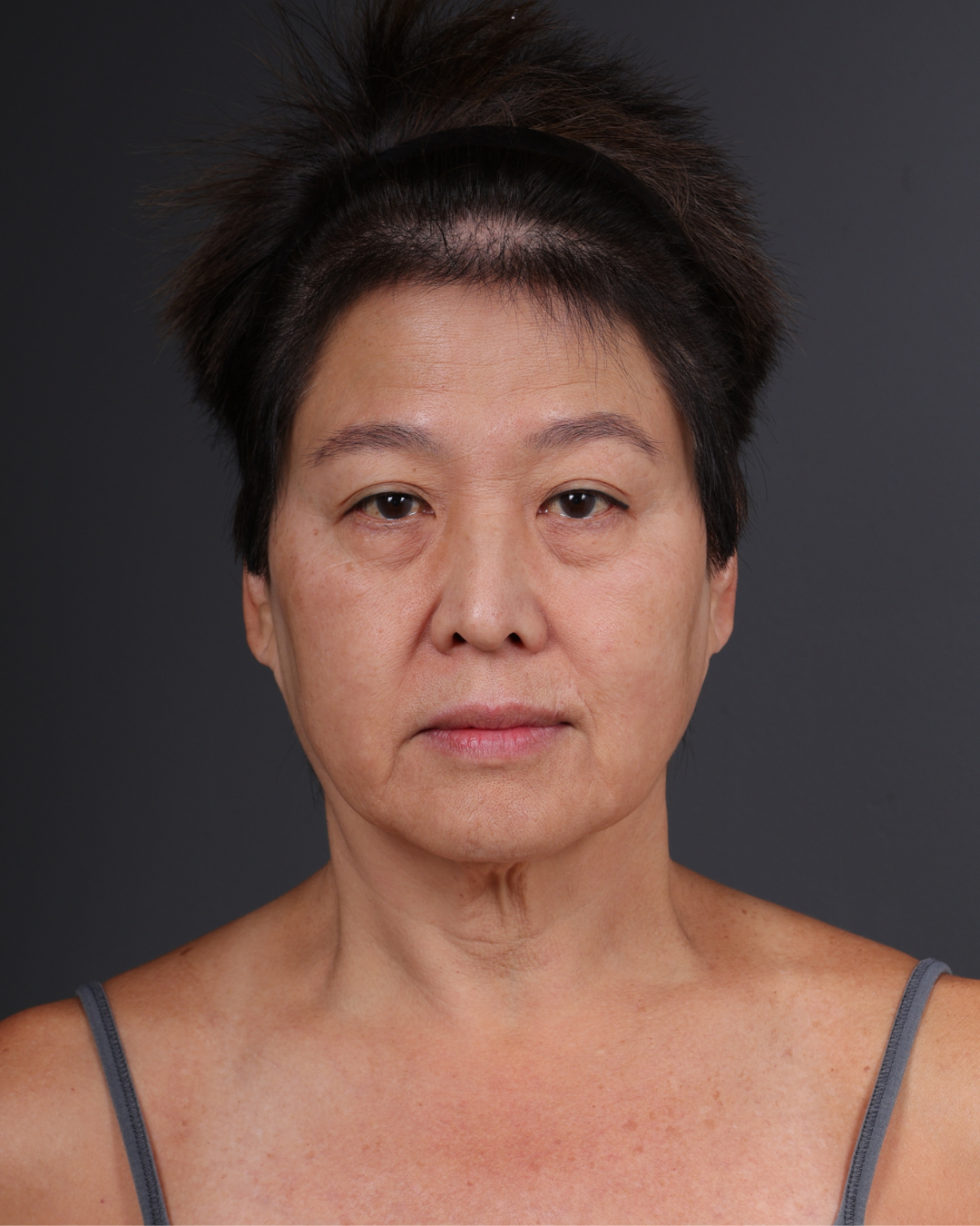 Facelift Before & After Gallery - Patient 285357 - Image 1