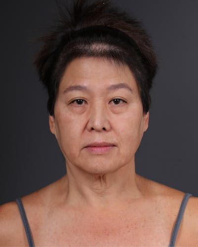 Facelift Before & After Gallery - Patient 285357 - Image 1