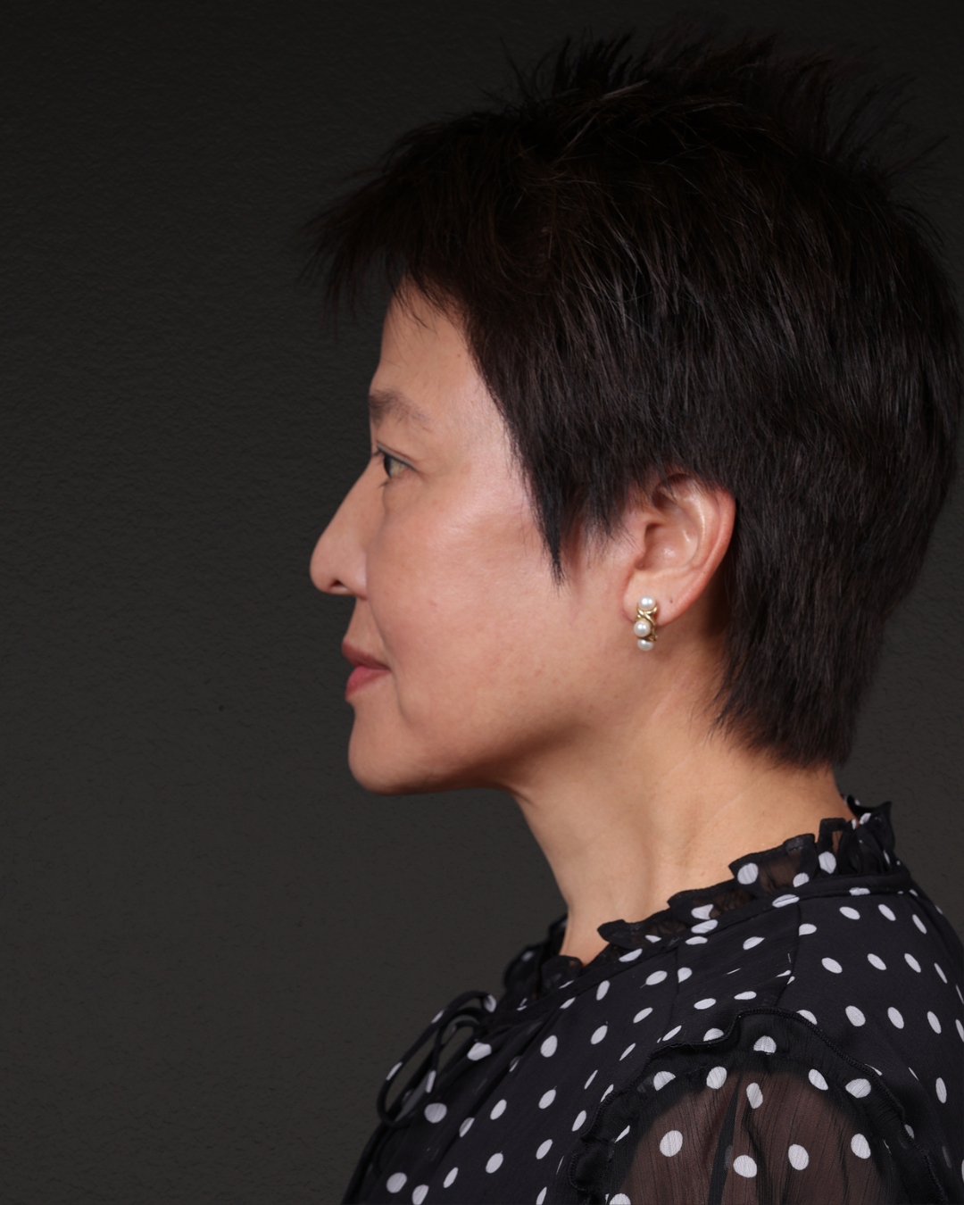 Facelift Before & After Gallery - Patient 285357 - Image 10