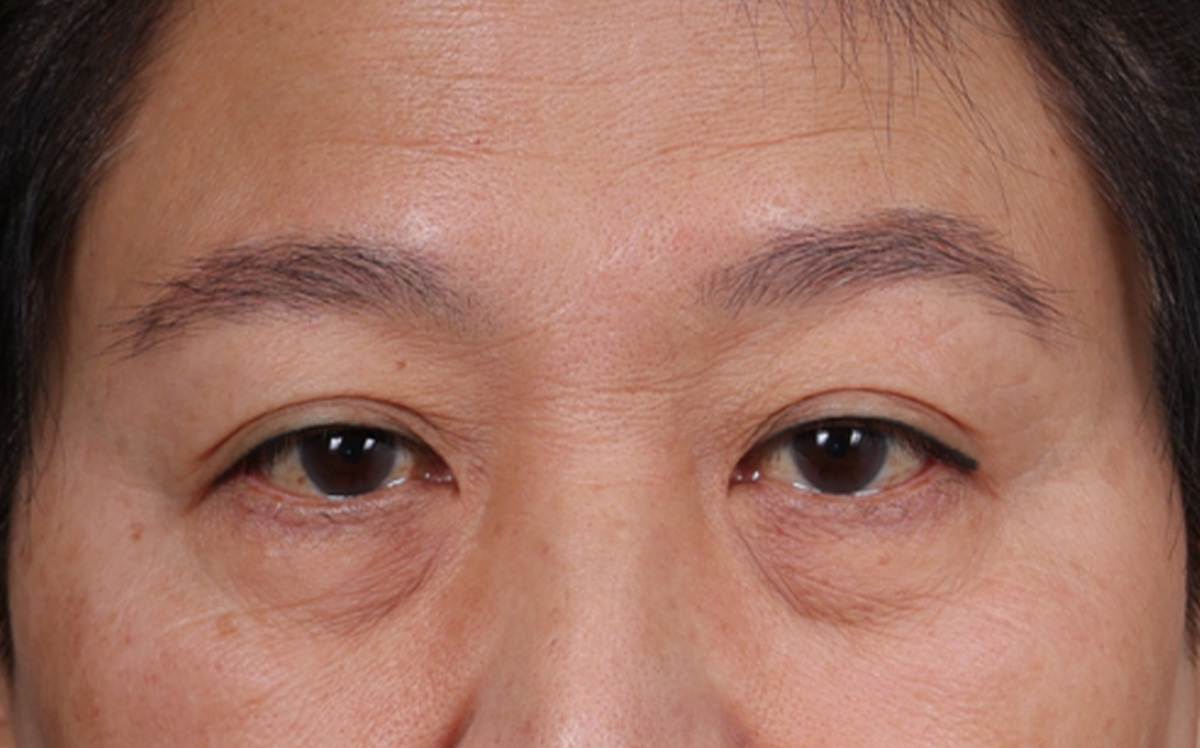 Blepharoplasty Before & After Gallery - Patient 114244 - Image 1