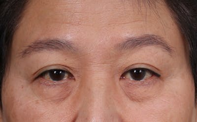 Blepharoplasty Before & After Gallery - Patient 114244 - Image 1