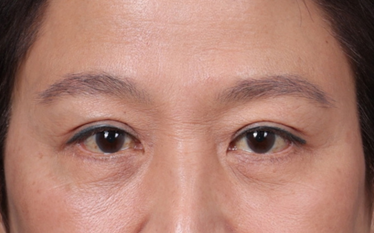 Blepharoplasty Before & After Gallery - Patient 114244 - Image 2