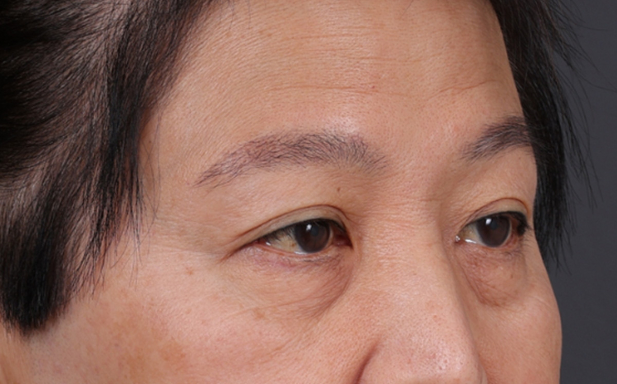 Blepharoplasty Before & After Gallery - Patient 114244 - Image 3