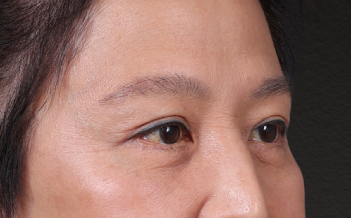 Blepharoplasty Before & After Gallery - Patient 114244 - Image 4