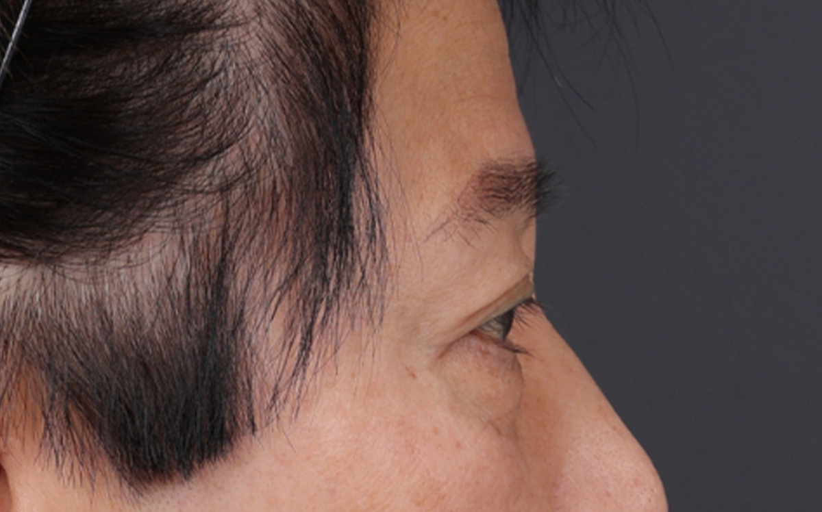 Blepharoplasty Before & After Gallery - Patient 114244 - Image 5