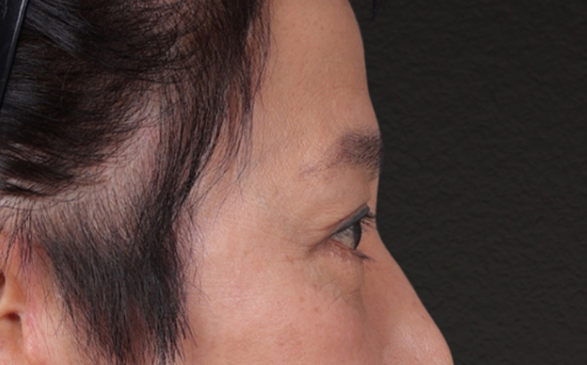 Blepharoplasty Before & After Gallery - Patient 114244 - Image 6