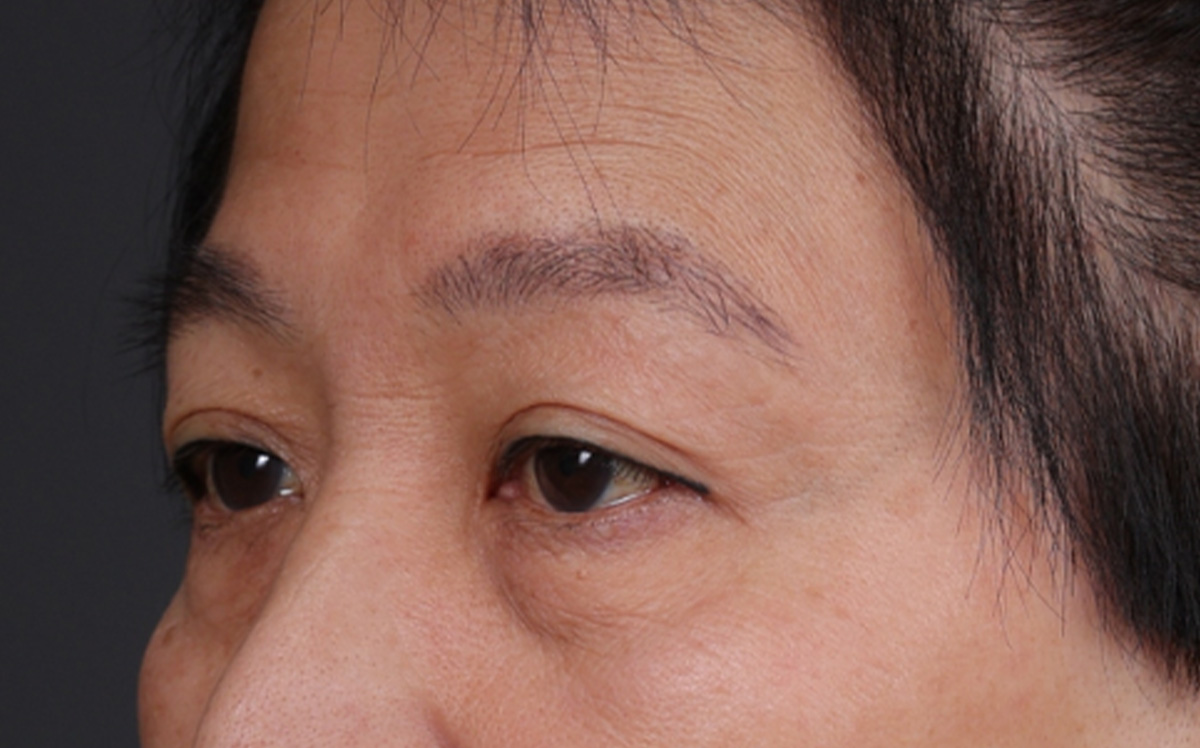 Blepharoplasty Before & After Gallery - Patient 114244 - Image 7