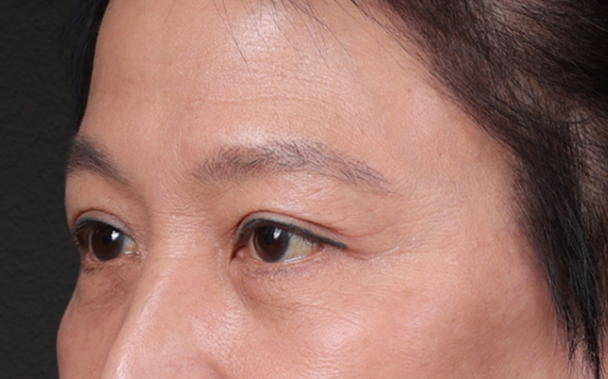 Blepharoplasty Before & After Gallery - Patient 114244 - Image 8