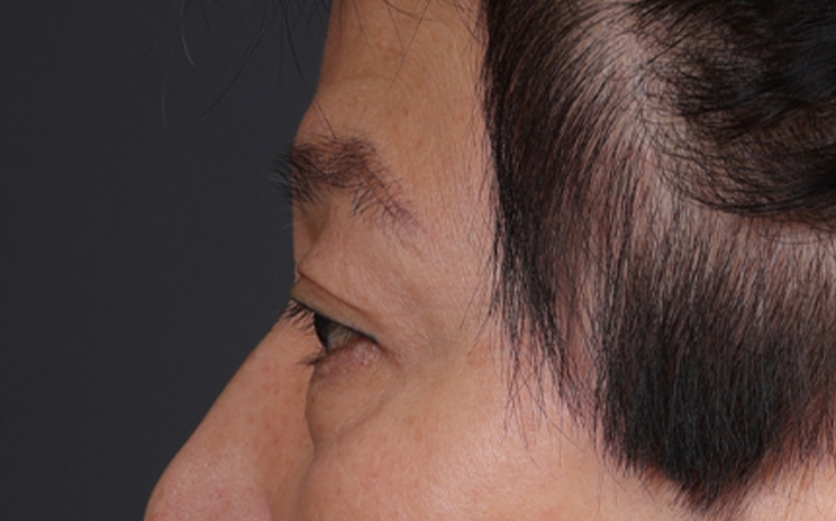 Blepharoplasty Before & After Gallery - Patient 114244 - Image 9