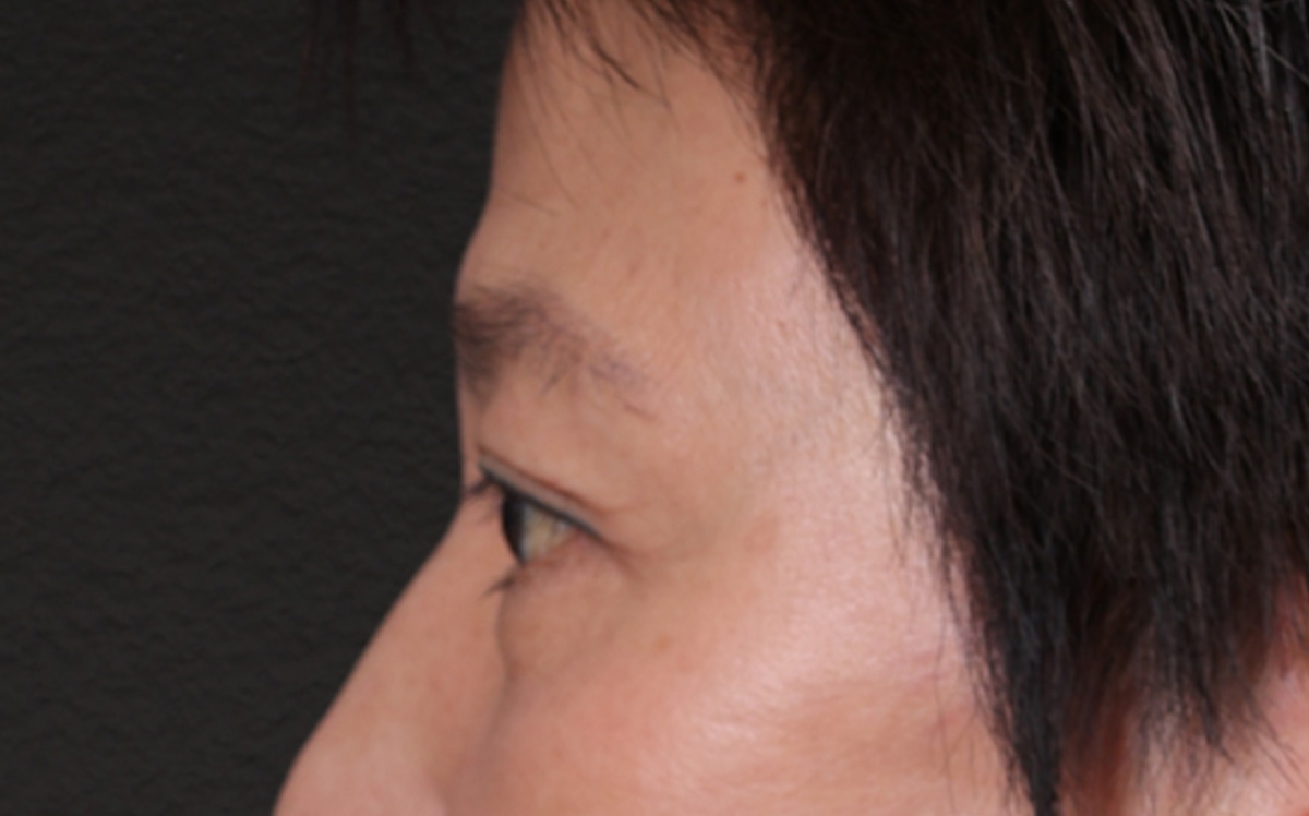 Blepharoplasty Before & After Gallery - Patient 114244 - Image 10