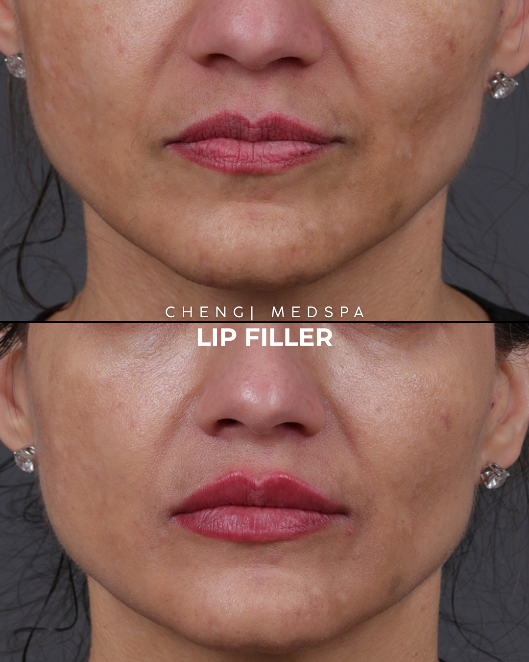Dermal Fillers Before & After Gallery - Patient 379790 - Image 1