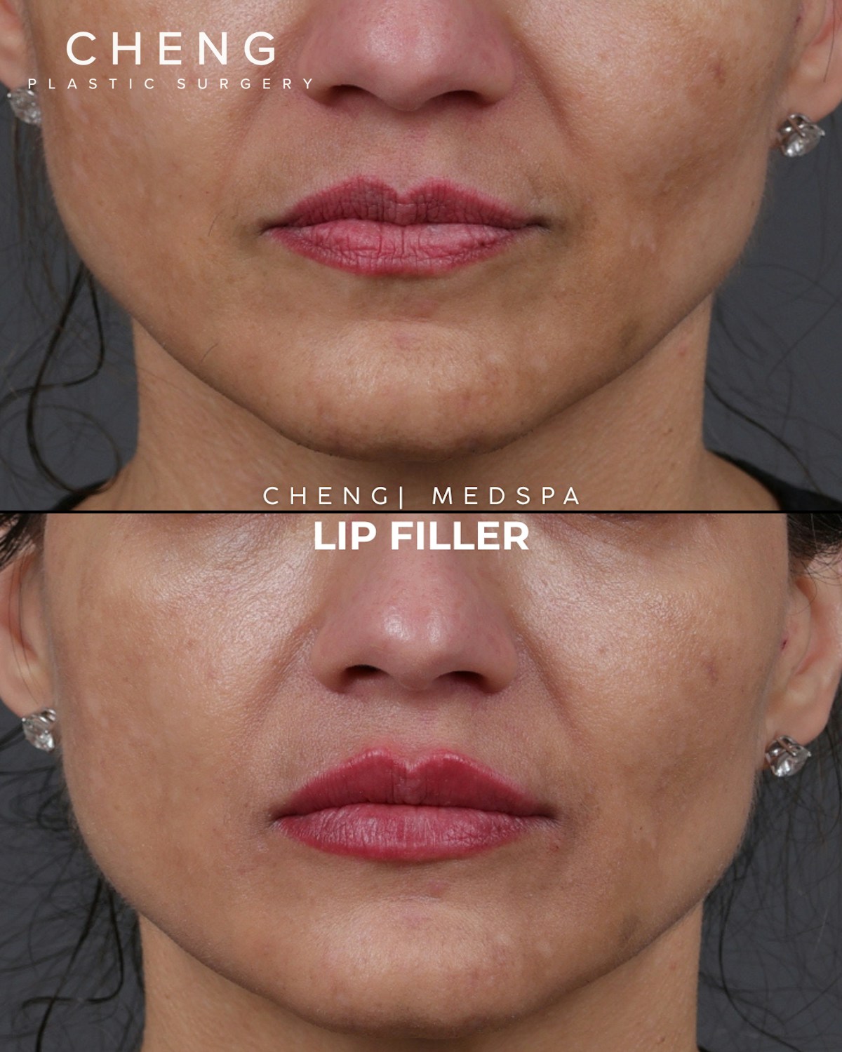 Dermal Fillers Before & After Gallery - Patient 379790 - Image 1