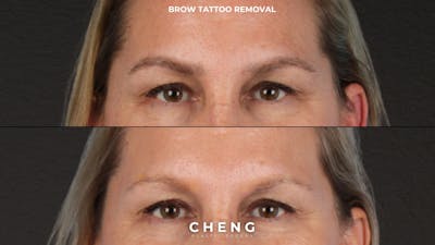 Laser Tattoo Removal Before & After Gallery - Patient 175645 - Image 1