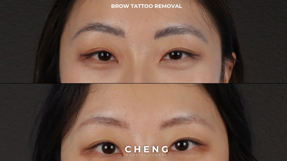 Laser Tattoo Removal Before & After Gallery - Patient 889037 - Image 1