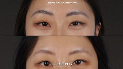 Laser Tattoo Removal Before & After Gallery - Patient 889037 - Image 1