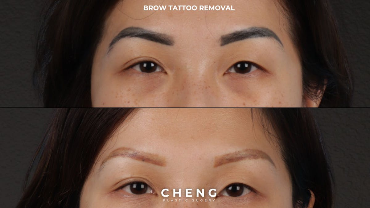 Laser Tattoo Removal Before & After Gallery - Patient 412607 - Image 1