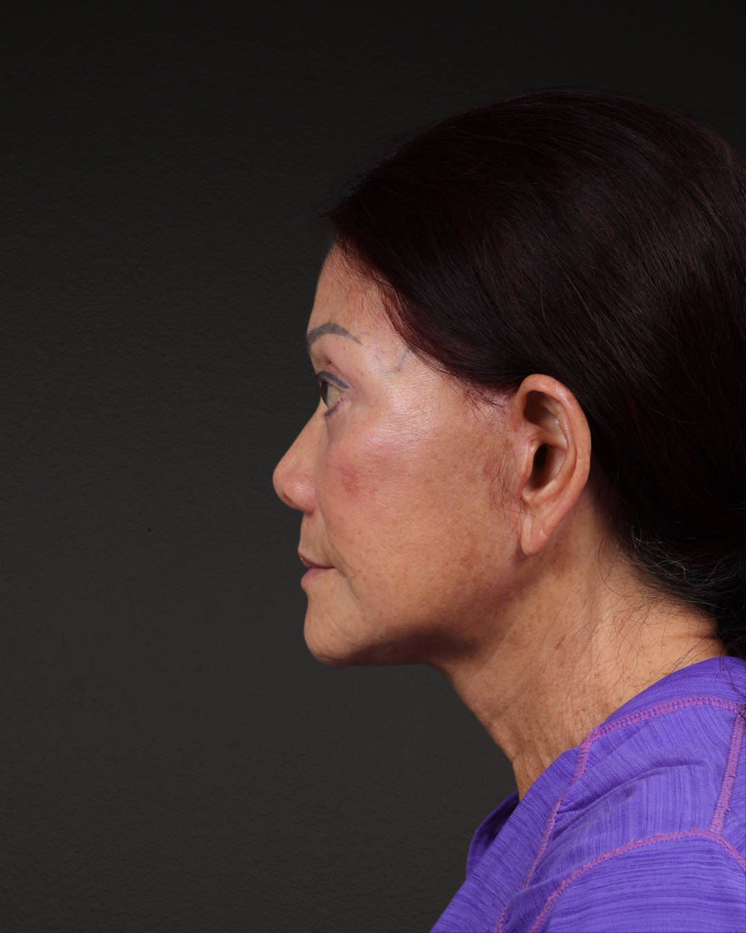 Neck Lift Before & After Gallery - Patient 187093 - Image 2
