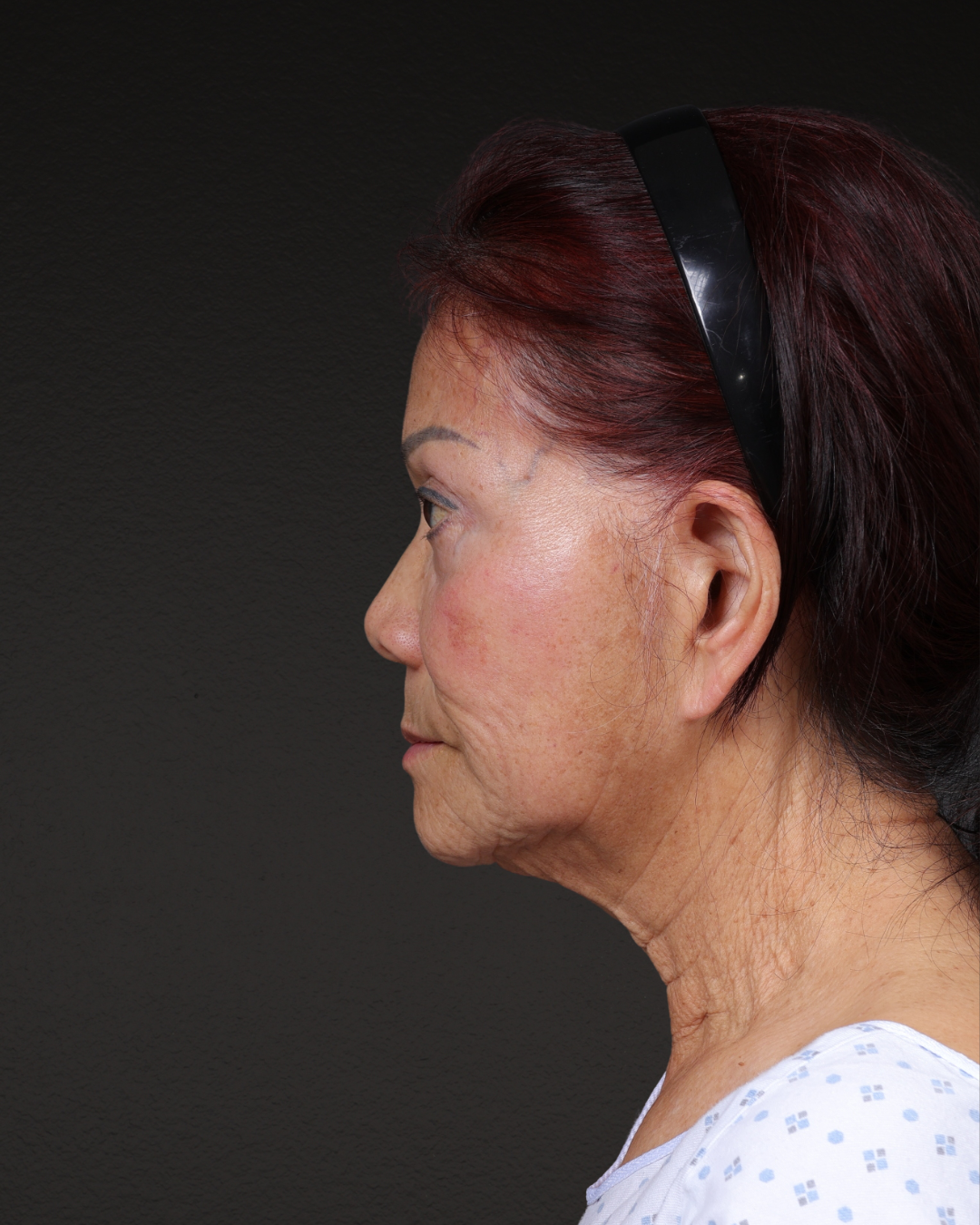 Neck Lift Before & After Gallery - Patient 187093 - Image 1