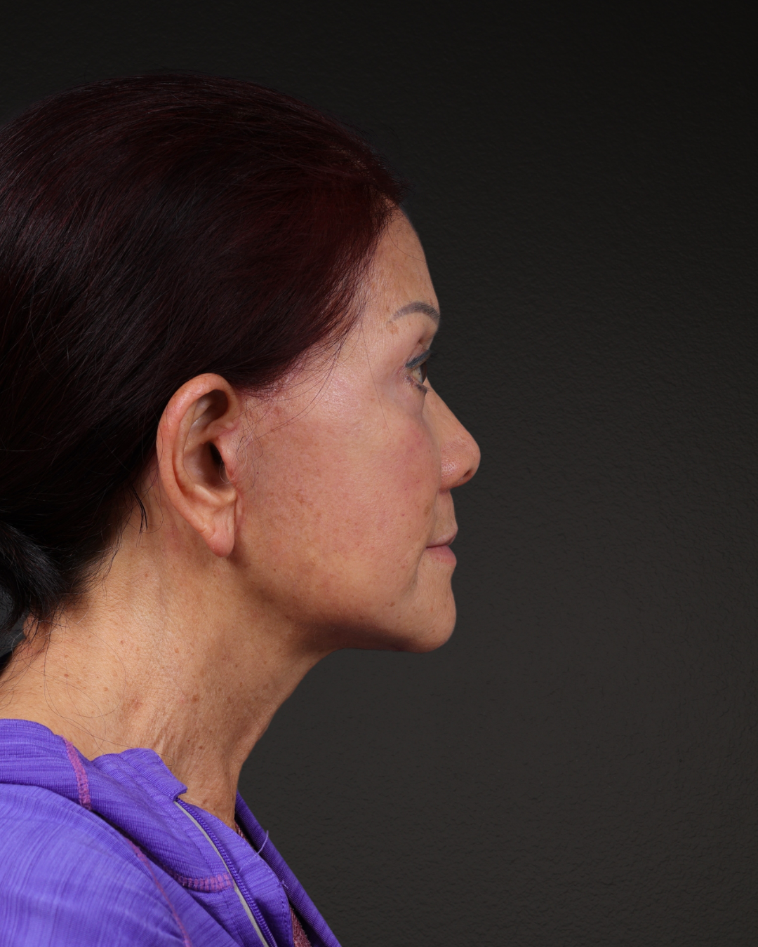 Neck Lift Before & After Gallery - Patient 187093 - Image 4
