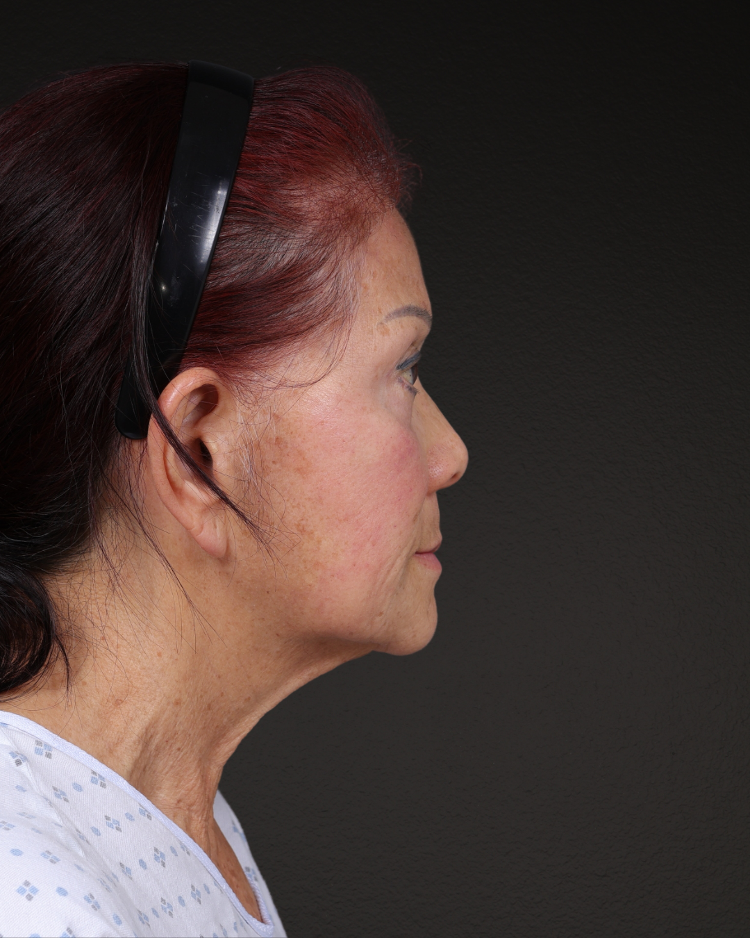 Neck Lift Before & After Gallery - Patient 187093 - Image 3