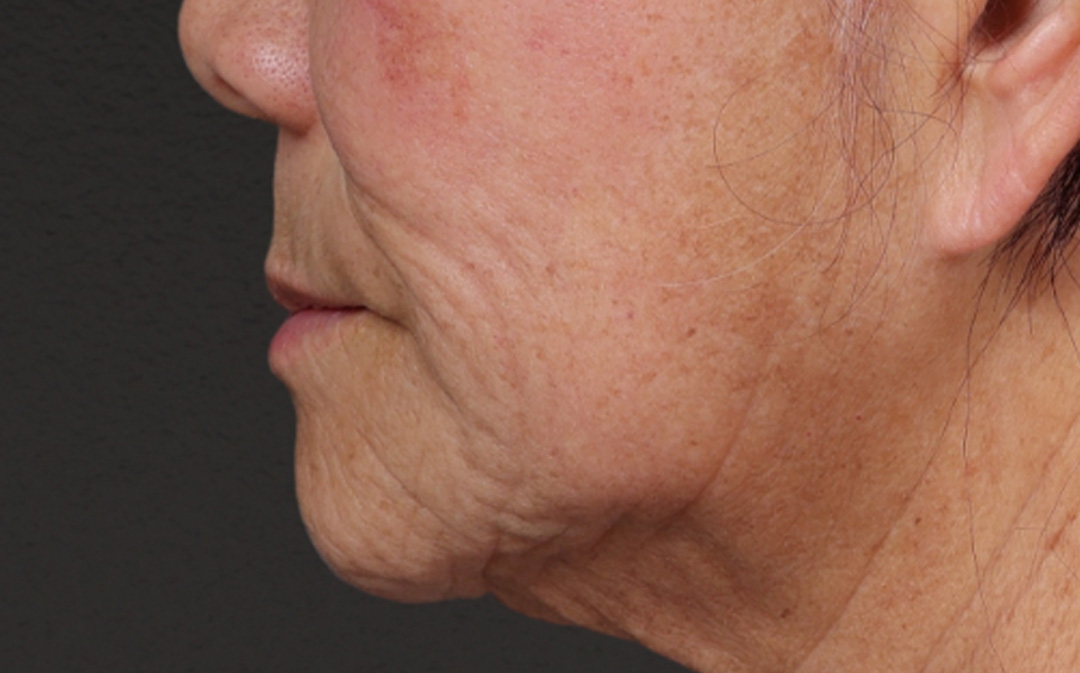 Lip Lift Before & After Gallery - Patient 250390 - Image 3
