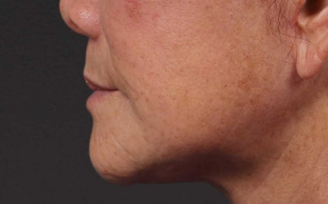 Lip Lift Before & After Gallery - Patient 250390 - Image 4