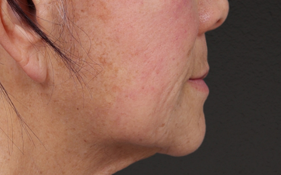 Lip Lift Before & After Gallery - Patient 250390 - Image 1