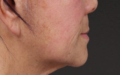 Lip Lift Before & After Gallery - Patient 250390 - Image 1