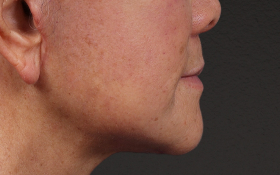 Lip Lift Before & After Gallery - Patient 250390 - Image 2