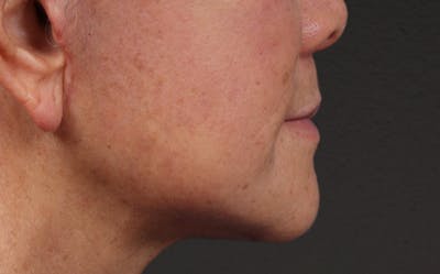 Lip Lift Before & After Gallery - Patient 250390 - Image 2