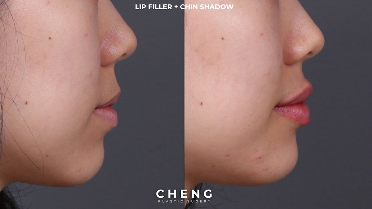 Dermal Fillers Before & After Gallery - Patient 377909 - Image 3