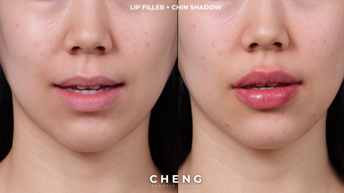 Dermal Fillers Before & After Gallery - Patient 377909 - Image 1